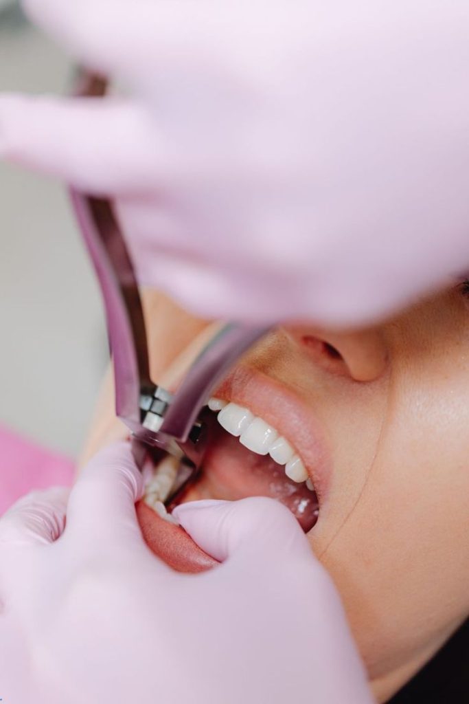 Wisdom tooth