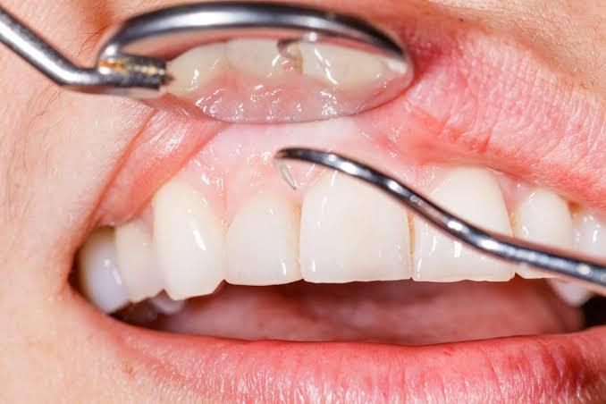 gum grafting