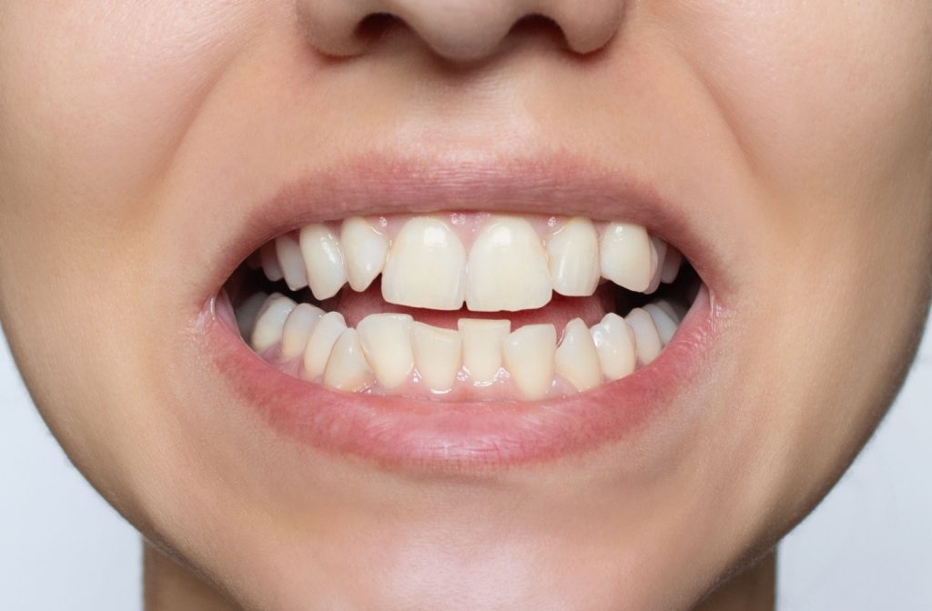 Veneers correcting minor tooth alignment